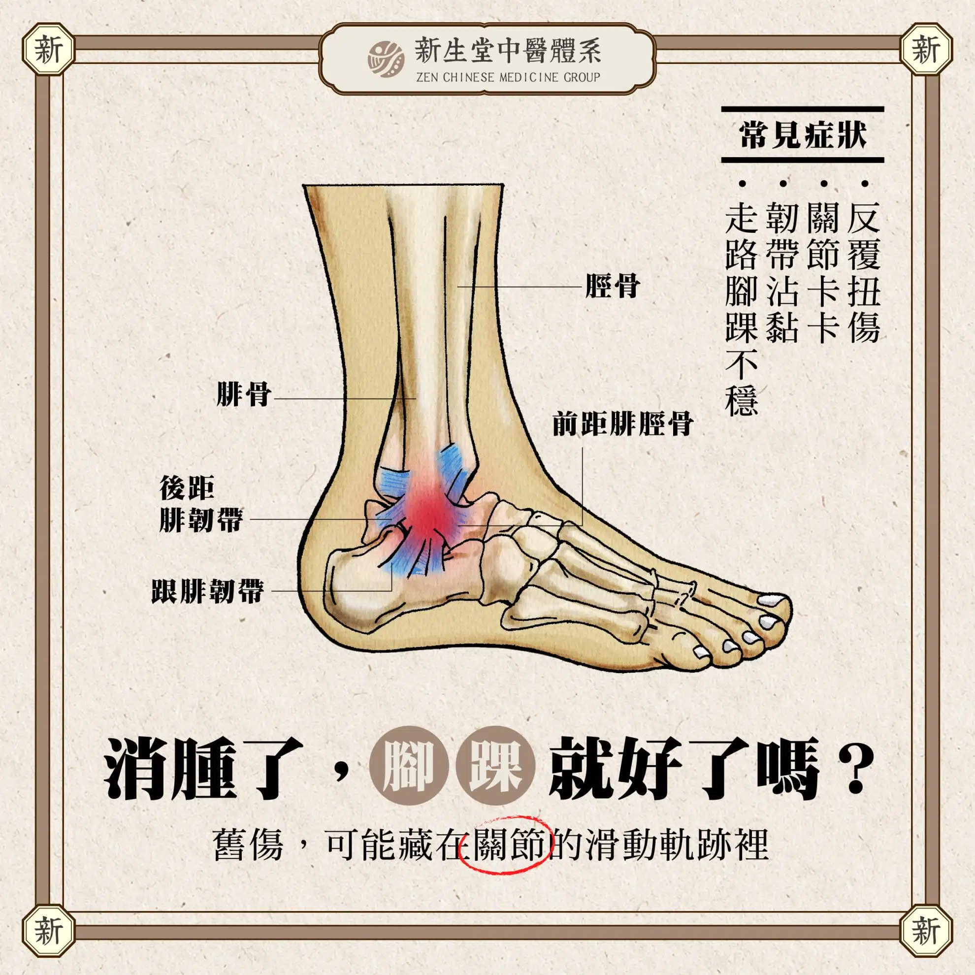 明明沒扭到,腳踝卻痛到爆? 中醫結構評估:距骨前移